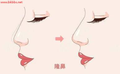 隆鼻术后多久恢复?
