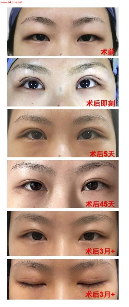 全切双眼皮术后多久能恢复自然?