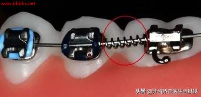 牙齿矫正是不是越快越好?淄博牙齿矫正要多久