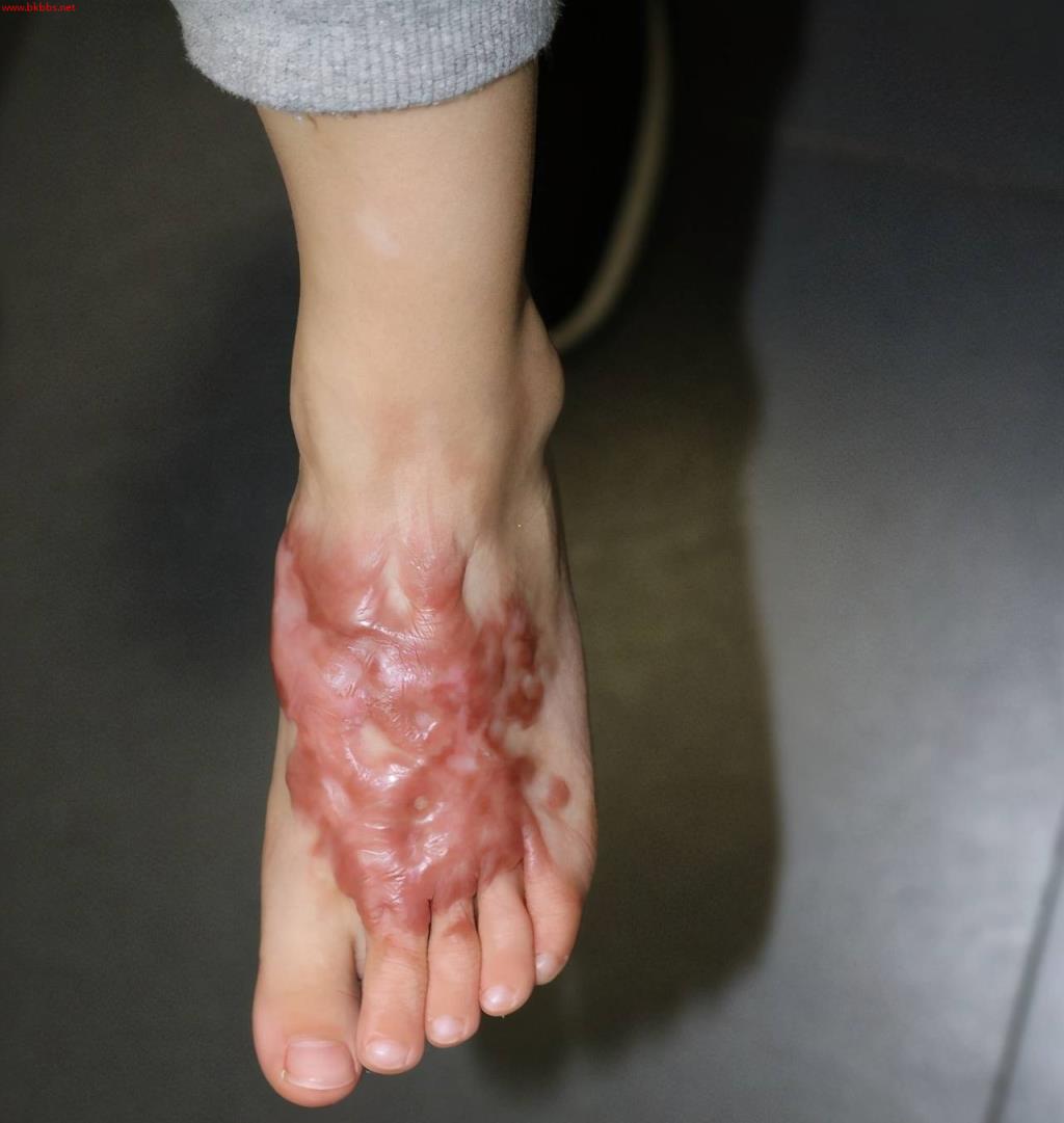 增生性疤痕后期会慢慢消退吗?