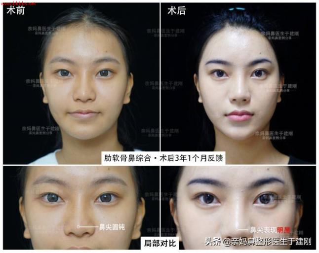 隆鼻手术里的假体,能安全使用几年?鼻整形医生与你说几句实话