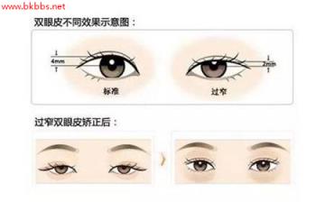 双眼皮修复为什么需要半年以上?