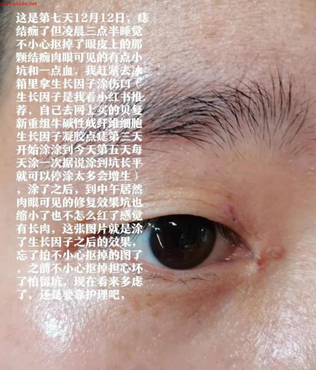 分享一下我在福州省立医院皮肤科点痣恢复过程