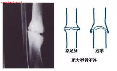 骨折几个月能走?骨折不愈合了再难行走,还好能治?