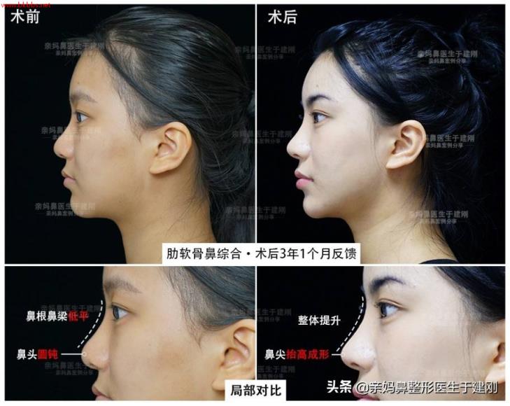 隆鼻手术里的假体,能安全使用几年?鼻整形医生与你说几句实话