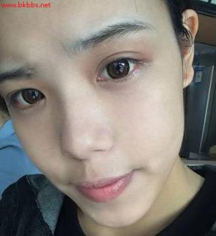 超真实!只用了32天,脸上8年的斑竟然全消失了