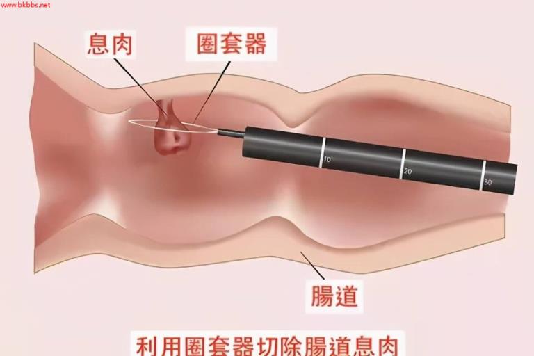 年过40就被逼着做肠镜?这是在救你