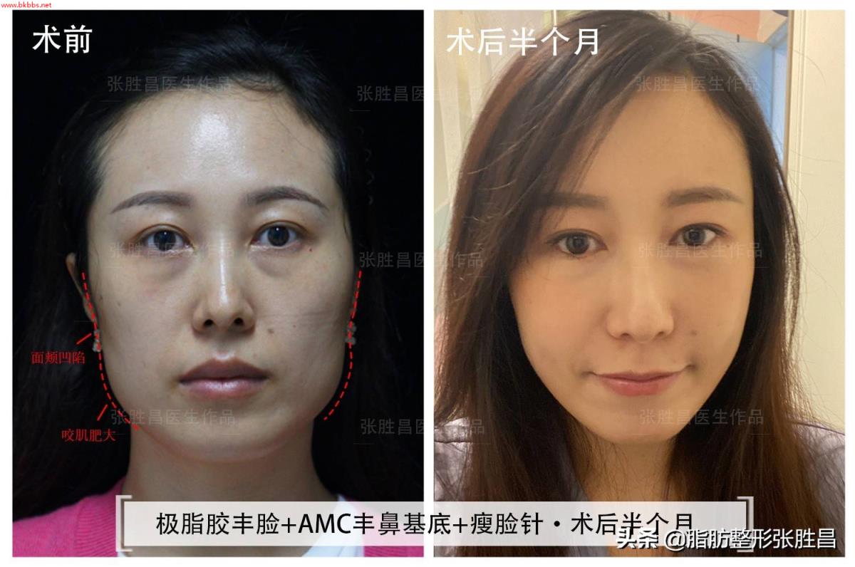 一次瘦脸针能保持多久?哪6类人不能打?经常注射的医生这样说