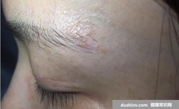 初期女性股癣图片及症状，大腿肚内侧长环状红斑有剧烈瘙痒