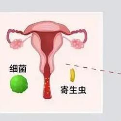 如何正确认识宫颈炎
