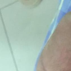 如何治疗干燥综合症