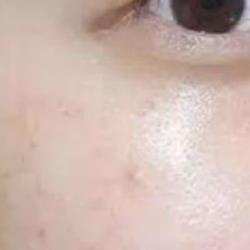 用了水杨酸脸颊泛红怎么补救