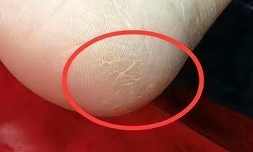 手脚脱皮的原因 八种方法预防脚脱皮