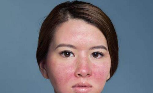 双颊和鼻子泛红，你可能得了玫瑰痤疮