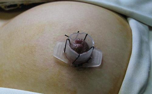 乳头内陷矫正后乳头有敏感度