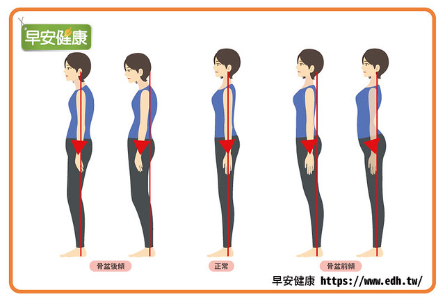 造成骨盆前倾、骨盆后倾的原因是骨盆平衡崩坏了!