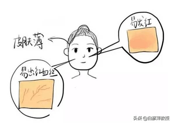 面部潮红,丘疹频发,滥用药膏的后果你可能想象不到
