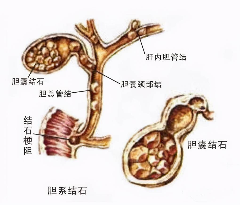 干货!肝内胆管结石术后护理要注意哪些?