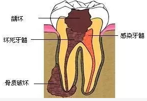 牙齿酸疼影响日常饮食,真的是仅是敏感问题吗?牙医教你怎么解决