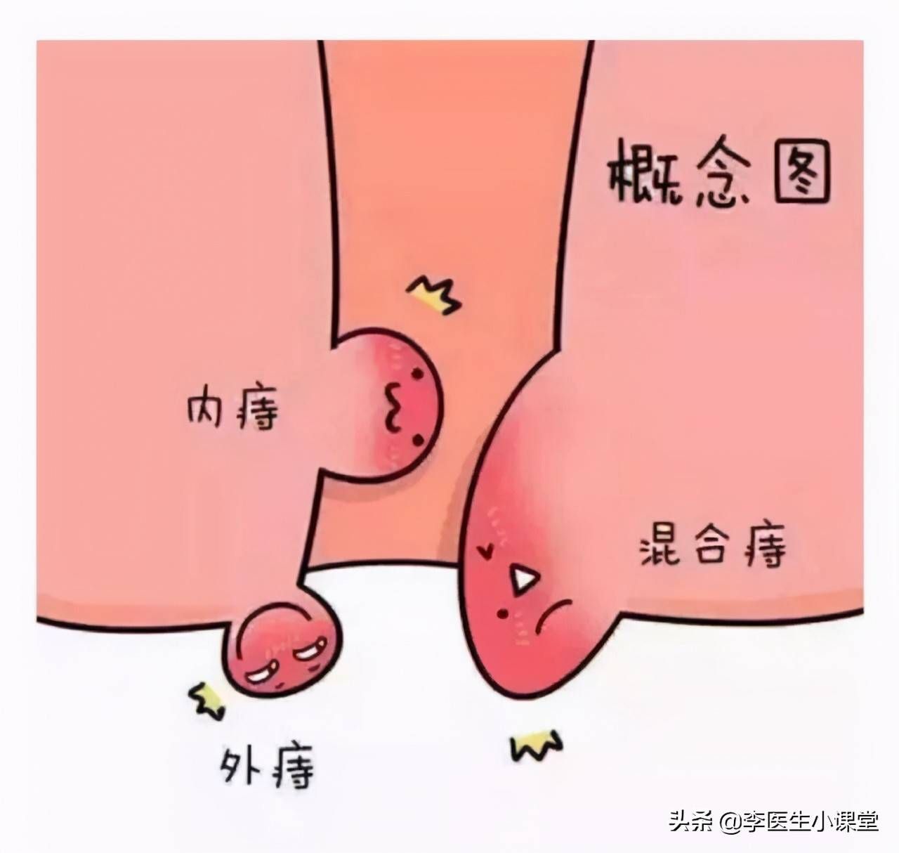 得了痔疮怎么办?医生:2个方法这么用,痔疮肉球没有了