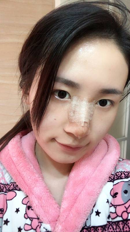 假体隆鼻半个月就不肿了,有些人说鼻梁太高?太假?