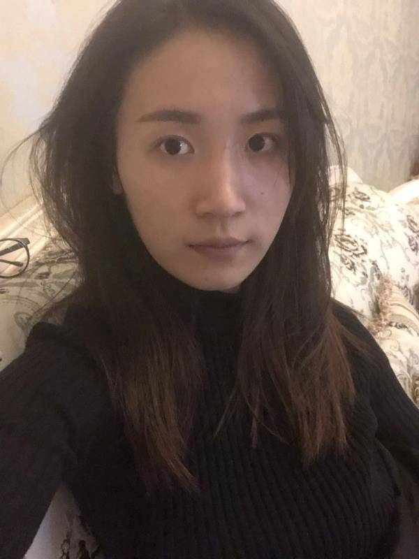 假体隆鼻半个月就不肿了,有些人说鼻梁太高?太假?