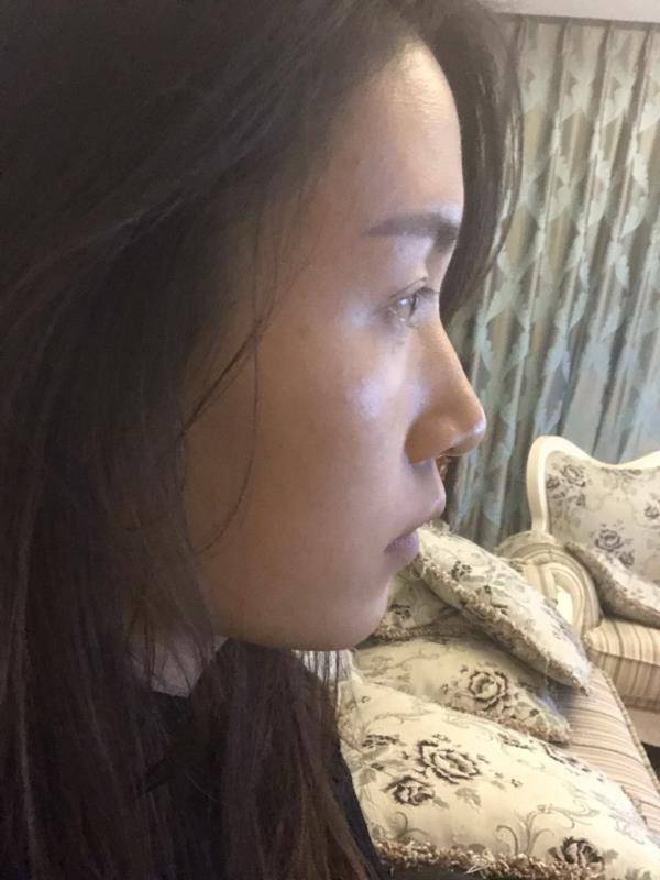 假体隆鼻半个月就不肿了,有些人说鼻梁太高?太假?