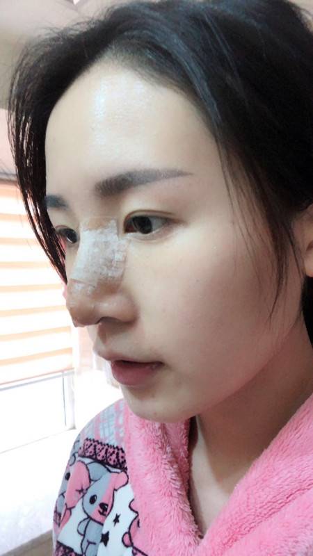 假体隆鼻半个月就不肿了,有些人说鼻梁太高?太假?
