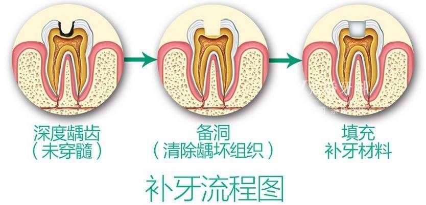 牙齿龋坏究竟要怎么办,补牙之后又能用多久呢?听听看牙医怎么说