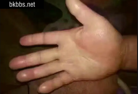 手脱皮是什么原因导致的4